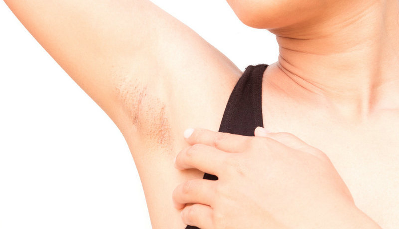 去腋毛會不會引起狐臭？有什么直接聯系嗎？