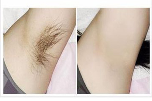 關于家用光子脫毛儀的小秘密（四）