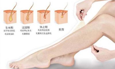 夏季脫毛：為什么有人說光子脫毛沒有效果？