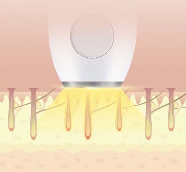 脫毛儀廠家諾鉑為您解疑：關于激光脫毛的六大問題(圖1)