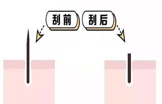 脫毛不徹底,毛毛的生命力到底有多頑強?(圖3) 脫毛不徹底,毛毛的生命力到底有多頑強?(圖3)