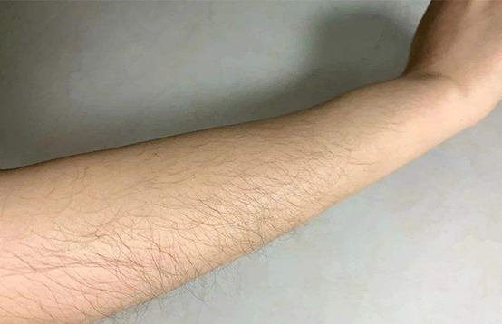 如何選擇一款有效的脫毛儀(圖1)