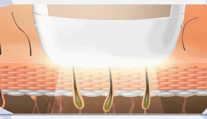 脫毛儀的選擇，冰點脫毛儀優先(圖2)